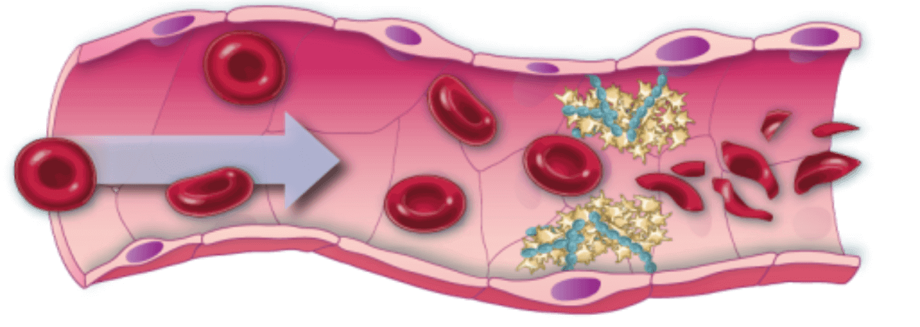 Blood clot in TTP
